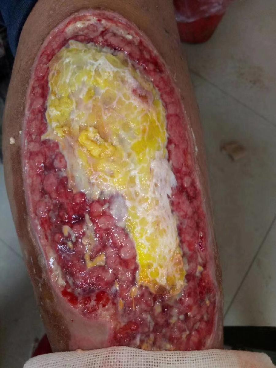 一木药业治愈烫伤实例（图3）