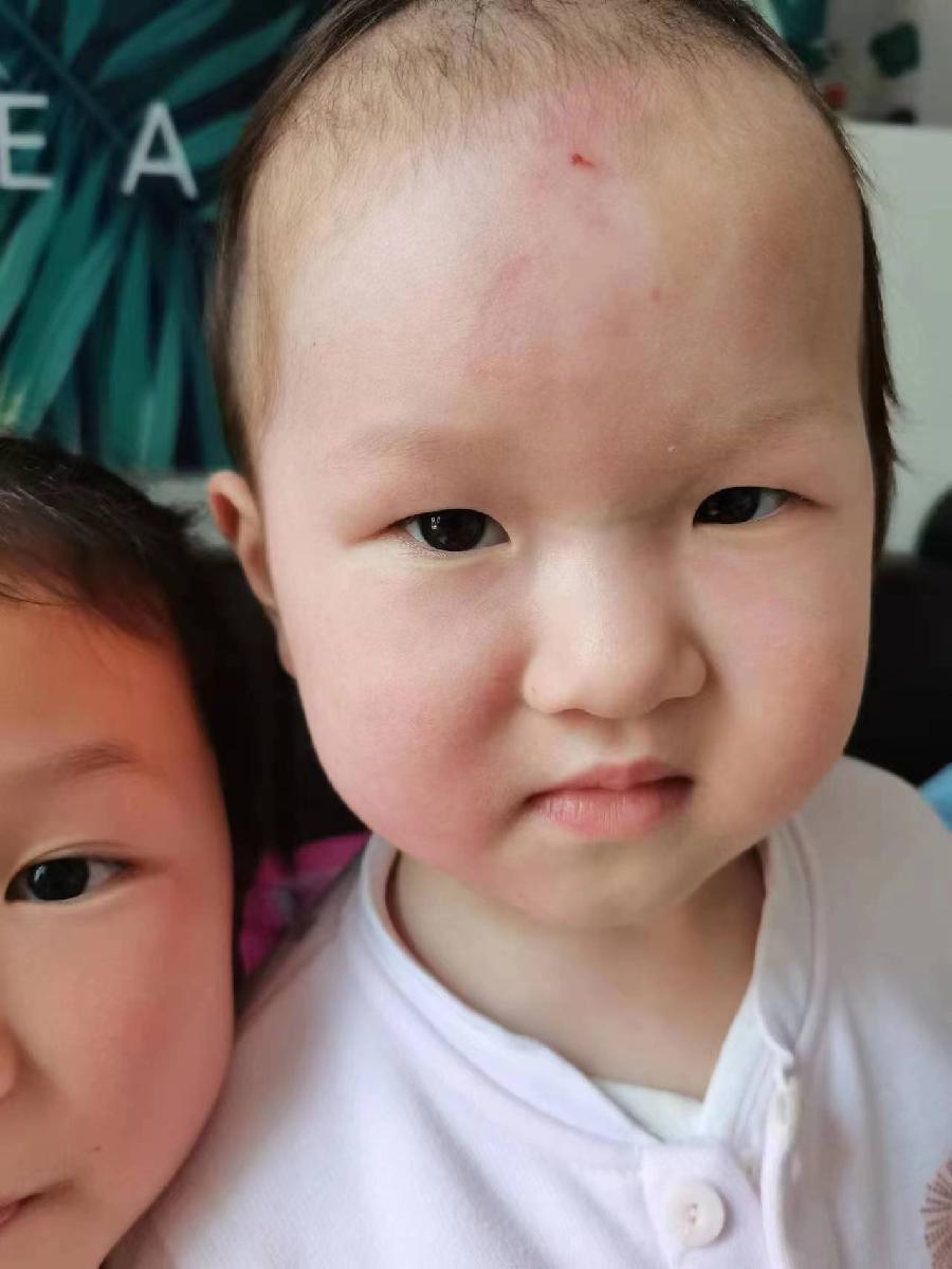 一木药业治愈烫伤实例（图6）