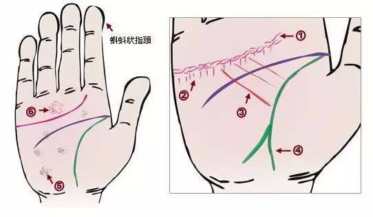 24种疾病的手诊特征（图15）