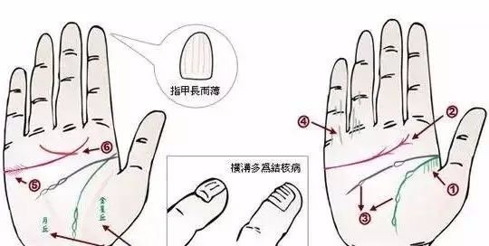 24种疾病的手诊特征（图25）
