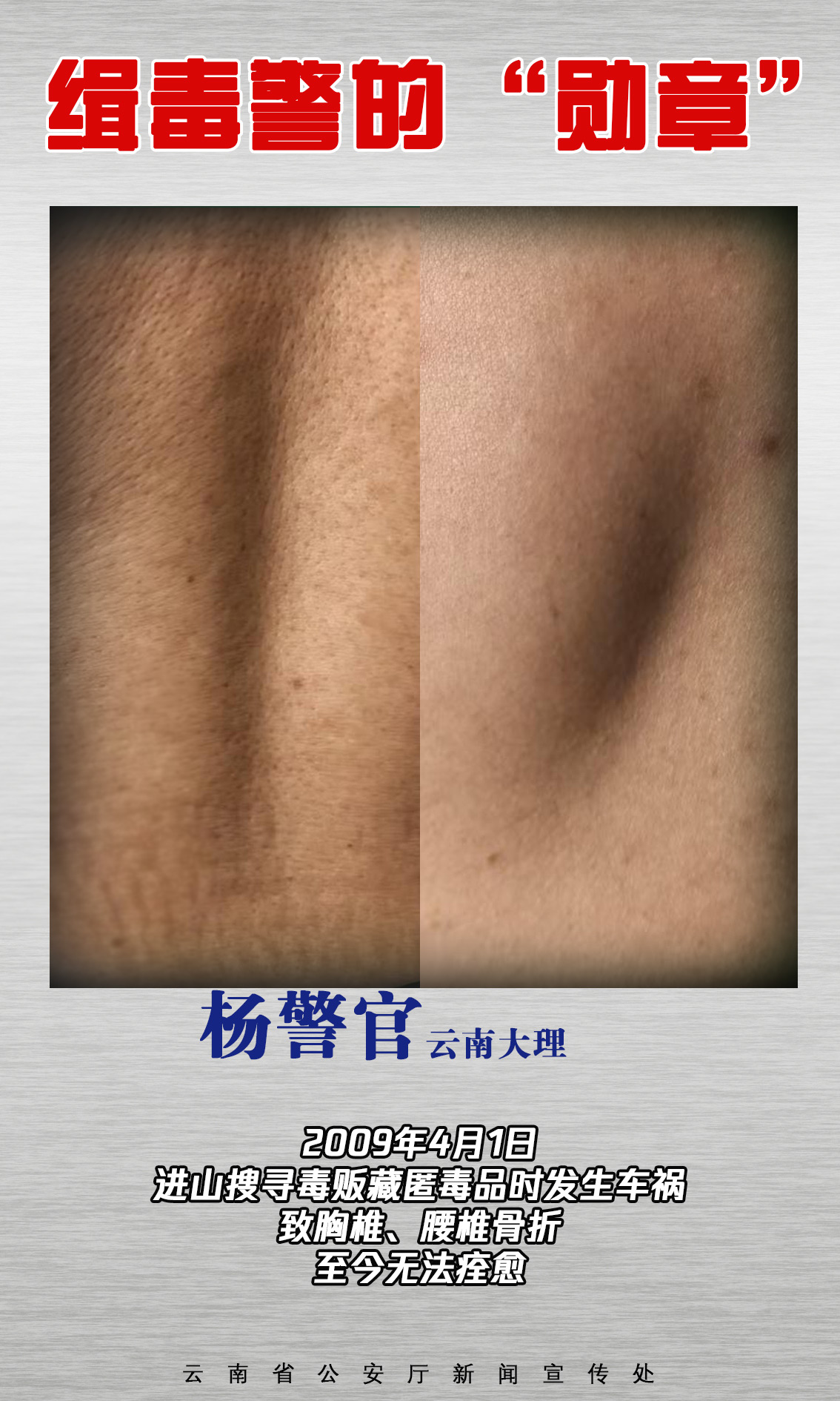 云南公安‖缉毒警的伤疤，是摘不掉的“勋章”（图4）
